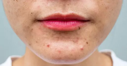 The causes of acne, as well as some treatment options that can help alleviate the symptoms