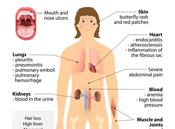 Lupus'un Gizemlerini Açığa Çıkarmak: Görünmez Bir Hastalığı Anlamak